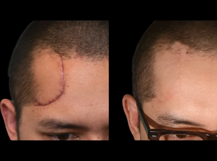 Scar Revision Tips